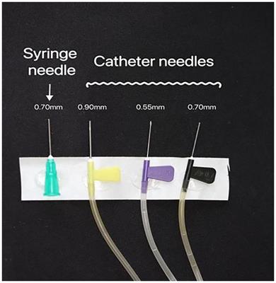 Effect of catheter needle caliber on polidocanol foam stability in foam sclerotherapy